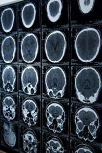 Brain Injury Lawyer In Oklahoma City